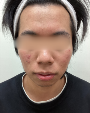頬の赤み治療(ACRS 3回)の症例写真[ビフォー]