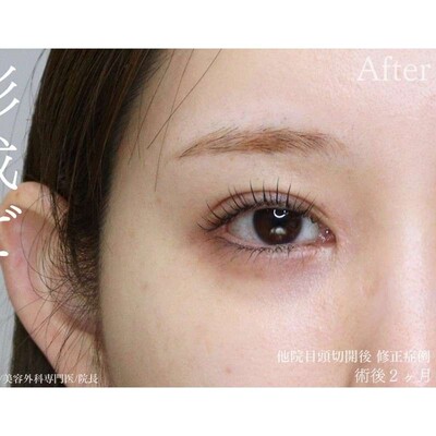 他院目頭切開後を蒙古襞形成（逆Z法）で修正の症例写真[アフター]
