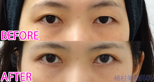 末広型の狭めの二重 二重埋没法 その他 二重整形 の症例写真 画像 植村美容外科 Cs 美容医療の口コミ広場