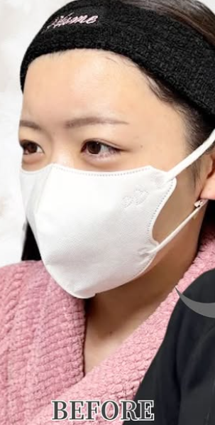 Plume Clinicの輪郭・顎・エラ・額・小顔整形の症例写真[ビフォー]