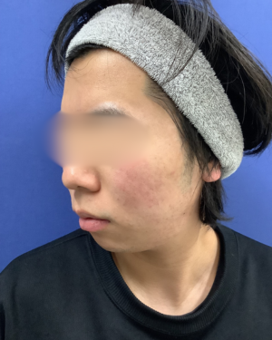 フェミークリニックの症例写真[アフター]