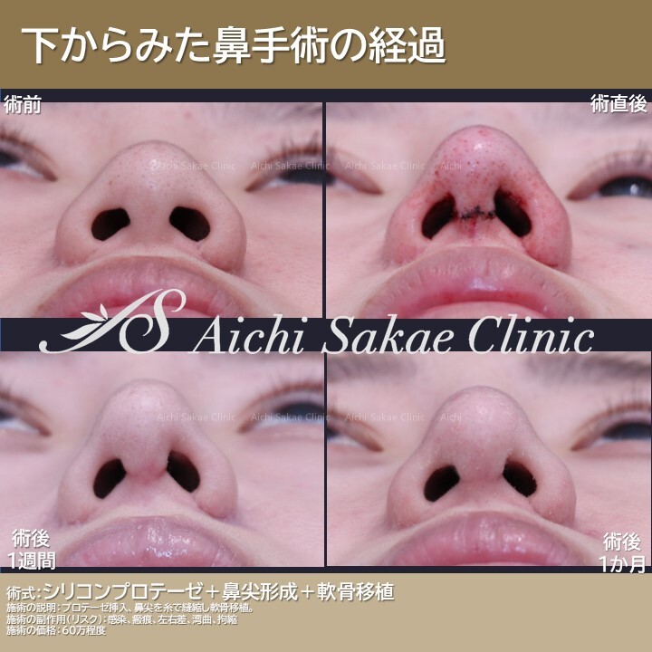 下からみた鼻手術の経過（鼻の整形）の症例写真 (CS72209)｜あいち
