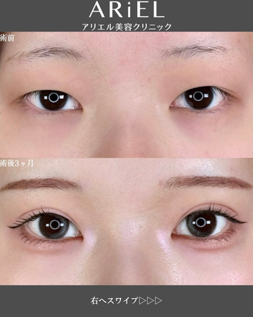 アリエル美容クリニック 郡山院の目・二重整形の症例写真