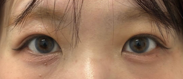 ユア美容クリニック 福岡院の症例写真[アフター]