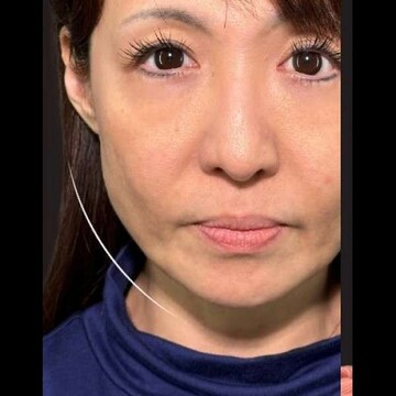 PRISM Beauty Clinicのリフトアップの症例写真[ビフォー]