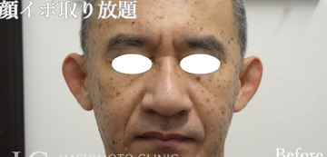 静岡美容外科橋本クリニックのほくろ除去・あざ治療・イボ治療の症例写真[ビフォー]