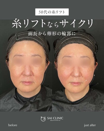 糸リフト（SAI LIFT STANDARD）14本の症例写真