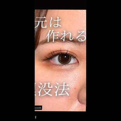 二重整形で憧れの目元に⭐️の症例写真[アフター]
