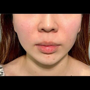 PRISM Beauty Clinicのリフトアップの症例写真[ビフォー]