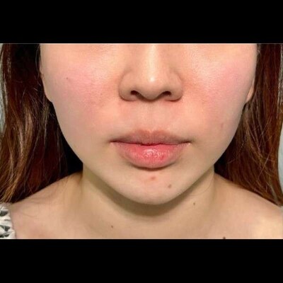 アルテミスリフト８本の症例写真[ビフォー]