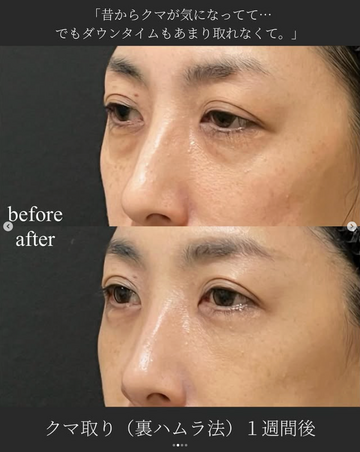 SAI CLINIC （サイクリニック）の目元・クマ・眉下・涙袋整形の症例写真