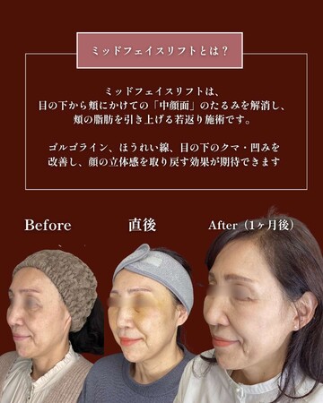 ギャラリークリニックの目元・クマ・眉下・涙袋整形の症例写真