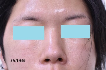 医療法人秀晄会 心斎橋コムロ美容外科クリニックのしわ・たるみ整形(注入、糸、フェイスリフト)の症例写真