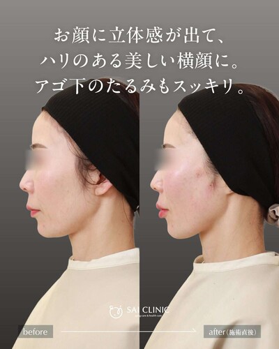 SAI LIFT STANDARD と 唇ヒアルロン酸の症例写真