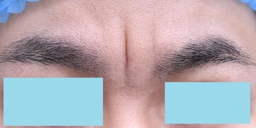医療法人秀晄会 心斎橋コムロ美容外科クリニックのしわ・たるみ整形(注入、糸、フェイスリフト)の症例写真[ビフォー]