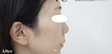 静岡美容外科橋本クリニックの症例写真[アフター]