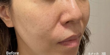 やさしい美容皮膚科・皮フ科 東京浅草院／シミレーザークリニックのシミ・肝斑の症例写真[ビフォー]
