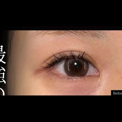 最強タレ目で可愛らしいお目元に💡の症例写真[ビフォー]