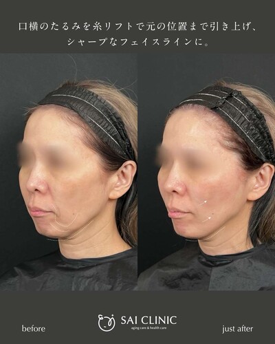 糸リフト：14本の症例写真