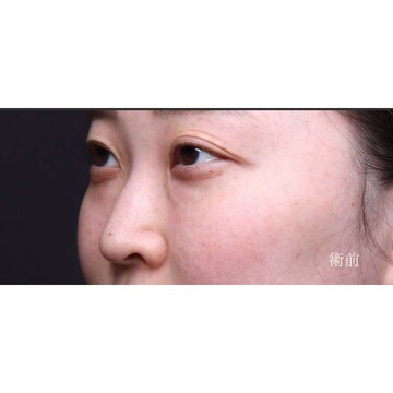 聖心美容クリニックの目元の症例写真[ビフォー]