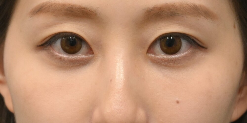 クマ取り ベーシック法 脱脂コンデンスリッチ 術前と１か月 目元整形 クマ治療の症例写真 画像 湘南美容クリニック 品川院 Cs 美容医療の口コミ広場