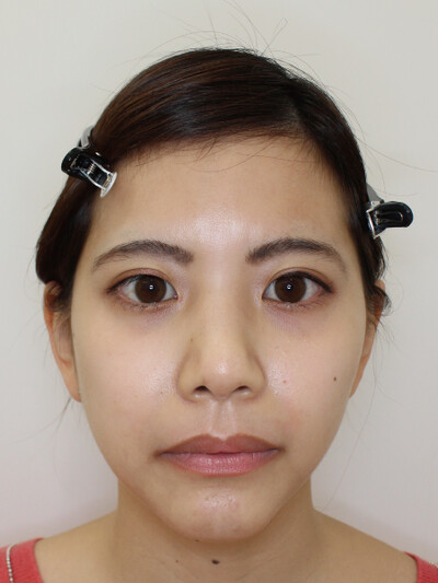 鼻中隔延長術の症例写真[アフター]