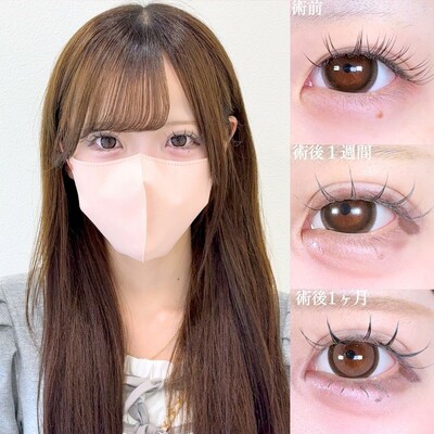アリエルクイックループダブル二重埋没法の症例写真