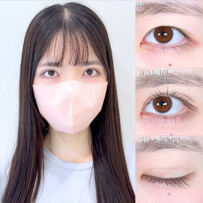 アリエルクイックループトリプルの症例写真