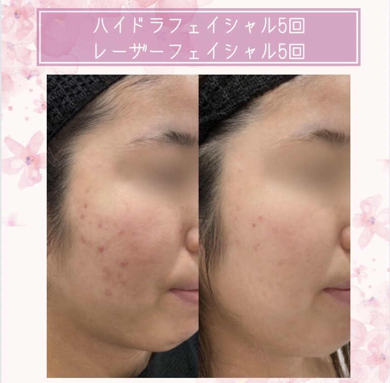 [20代 女性] ハイドラフェイシャル5回 レーザーフェイシャル5回（ニキビ・ニキビ跡の治療）の症例写真 (CS73681)｜さっぽろ美容 ...