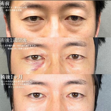 アリエル美容クリニック 大宮院の目元・クマ・眉下・涙袋整形の症例写真