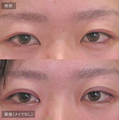 切らない二重手術 LS法シングル (ロングプラン)の症例写真