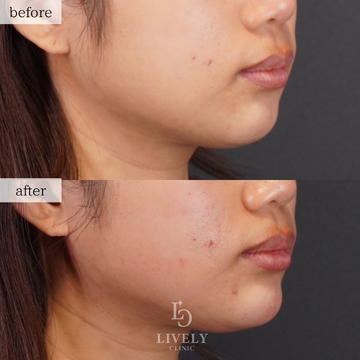 LIVELY CLINIC 浜松町院の輪郭・顎・エラ・額・小顔整形の症例写真