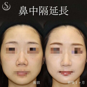 聖心美容クリニックの鼻の整形の症例写真