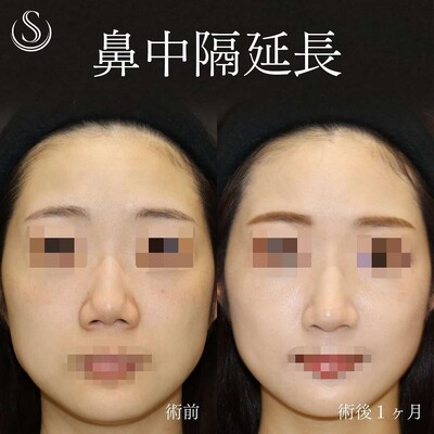 他院アクアミド除去と鼻中隔延長で鼻先改善の症例写真