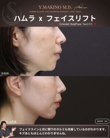 聖心美容クリニックのしわ・たるみ整形(注入、糸、フェイスリフト)の症例写真