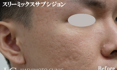 ニキビ跡に対するサブシジョン施術の症例写真[ビフォー]