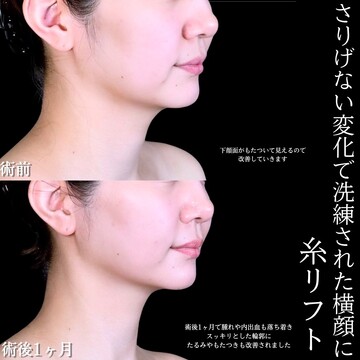 アリエル美容クリニック 大宮院のしわ・たるみ整形(注入、糸、フェイスリフト)の症例写真