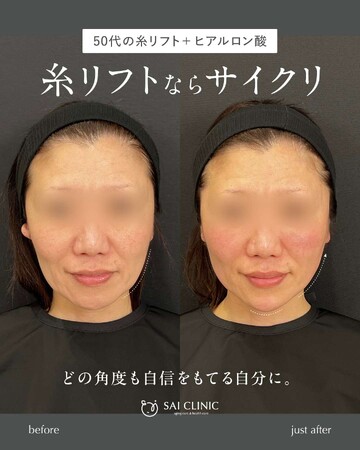 SAI CLINIC （サイクリニック）のリフトアップの症例写真