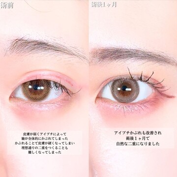 アリエル美容クリニック 大宮院の二重の症例写真