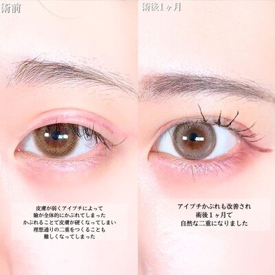 アリエルクイックループダブル二重埋没法の症例写真