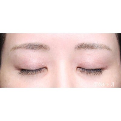 目上切開で目を寄せずに丸く自然な目元へ（術後6ヶ月）の症例写真[アフター]