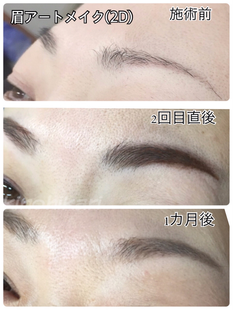 眉アートメイク グラデーション2d 眉のアートメイクの症例写真 画像 樹のひかり 形成外科 皮ふ科 Cs 美容医療の口コミ広場