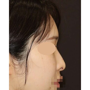 聖心美容クリニックの鼻の症例写真[ビフォー]