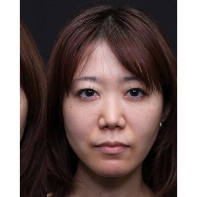 裏ハムラ法で埋もれた涙袋と目元の影を改善の症例写真[アフター]