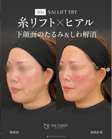 SAI CLINIC （サイクリニック）のリフトアップの症例写真