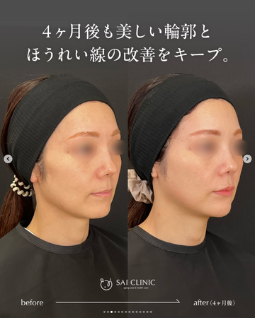 SAI CLINIC （サイクリニック）のリフトアップの症例写真