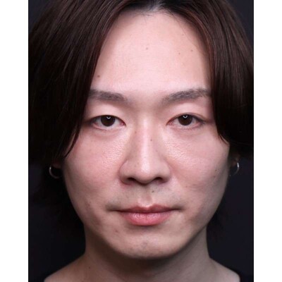 30代男性の裏ハムラ法で目元の影を改善（術後1ヶ月）の症例写真[アフター]