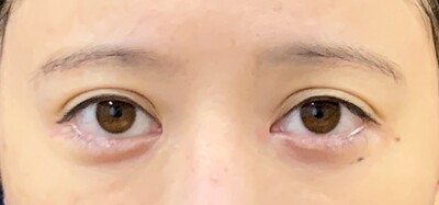 他院目頭切開術後の症例写真[ビフォー]