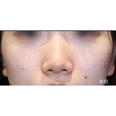土手を温存した小鼻縮小（内外側法）で自然な小鼻にの症例写真[ビフォー]