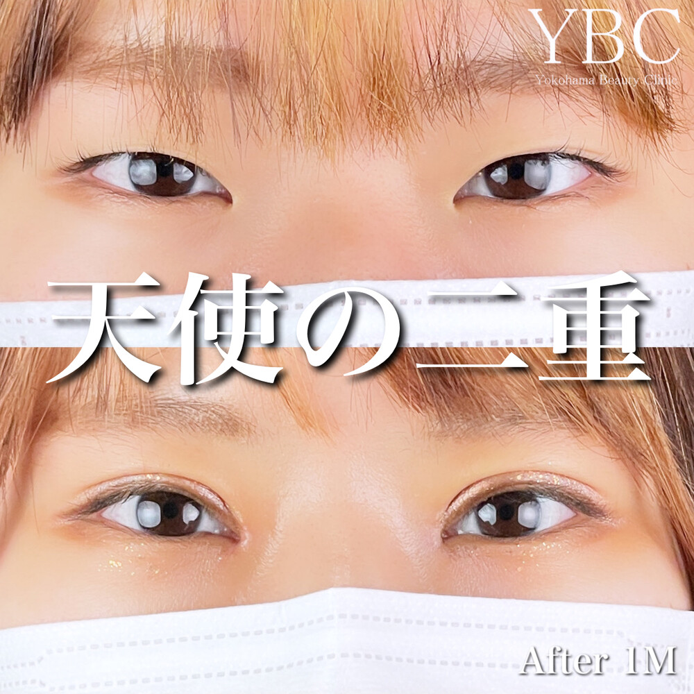 生まれつきのような天使の二重 目 二重整形の症例写真 画像 Ybc横浜美容外科 大宮院 Cs 美容医療の口コミ広場